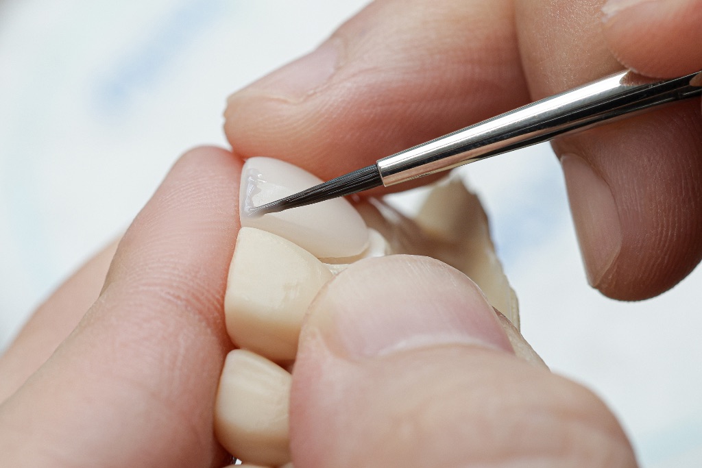 글로우네이트 라미네이트 정밀 세팅 — 원내 기공소에서 포세린 라미네이트를 핀셋으로 정밀하게 다듬는 모습