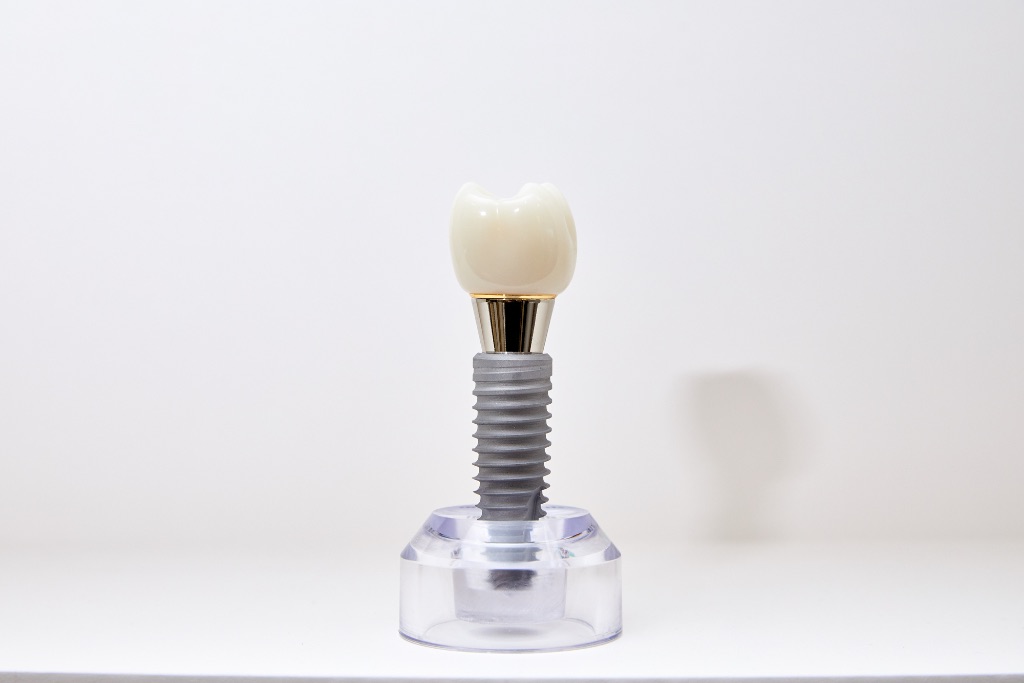 임플란트 구조 모형